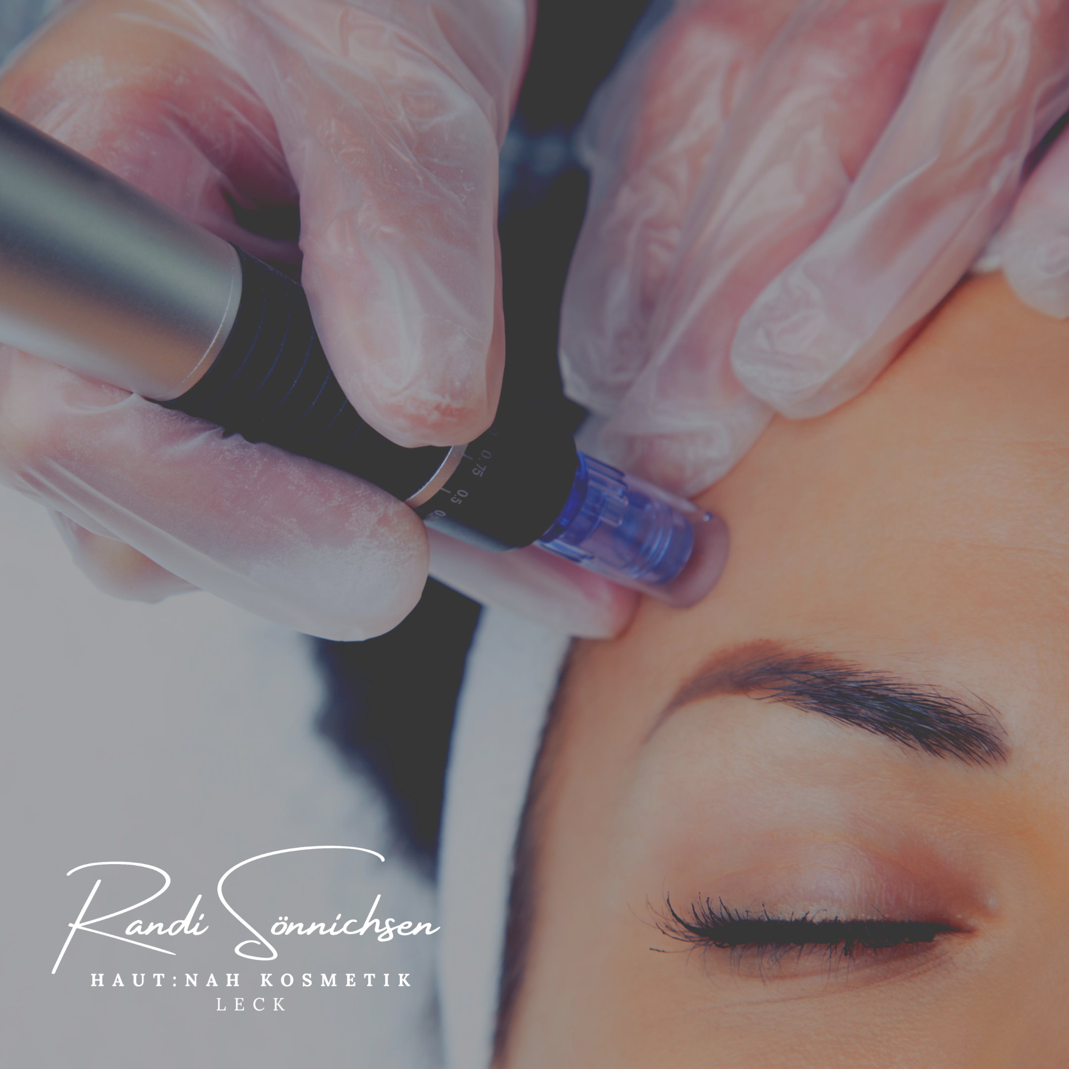 Featured image for “NEU: Microneedling Falten Spezial – Botoxeffect”